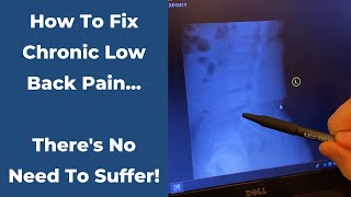 Address This Underlying Cause & Get Relief Burleson Chiropractor Dr. Pettke Explains How