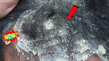 Dandruff Shampoo and Scratching, Itchy Dry Scalp, Huge Flake - Psoriasis #291