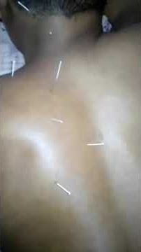 rematik ternyata bisa sembuh dengan terapi akupunktur