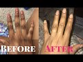 GET RID OF DARK KNUCKLES INSTANTLY HOME REMEDIES IN DAYS/WORKS LIKE MAGIC