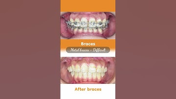 Hành trình LỘT XÁC nhờ niềng răng của Kim Ngọc  #updental #braces