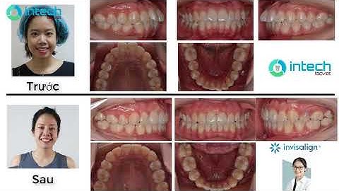 KH Nguyễn Thu Thủy - Niềng răng hô bằng invisalign