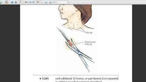 Integumentary system - Skin Tags- Current Procedural Terminology