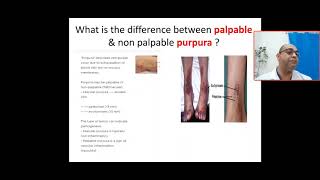 What's the difference between palpable & non palpable purpura? platelet, coagulation, vascular cause