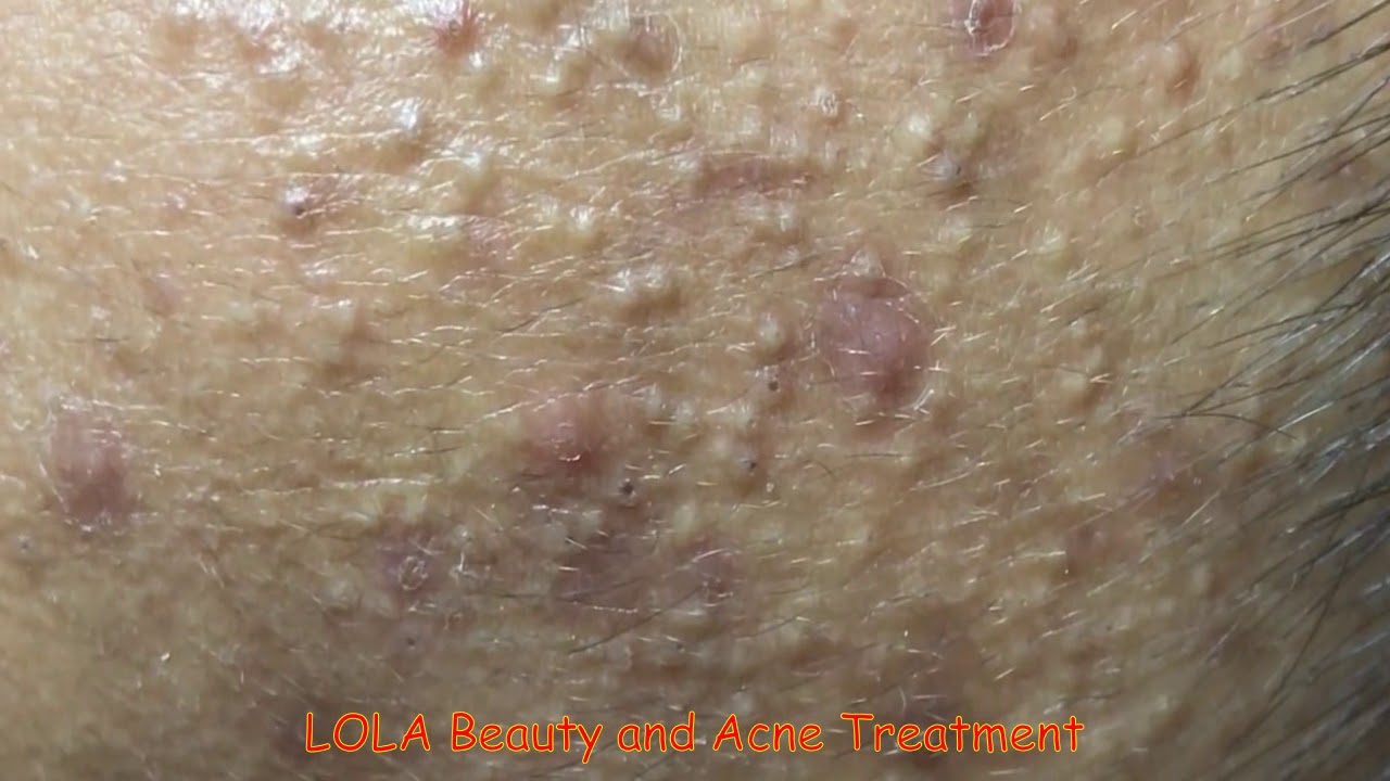 Are These Ant Bites?; Acne Removal 42;  (Full Screen) Super Big Pops