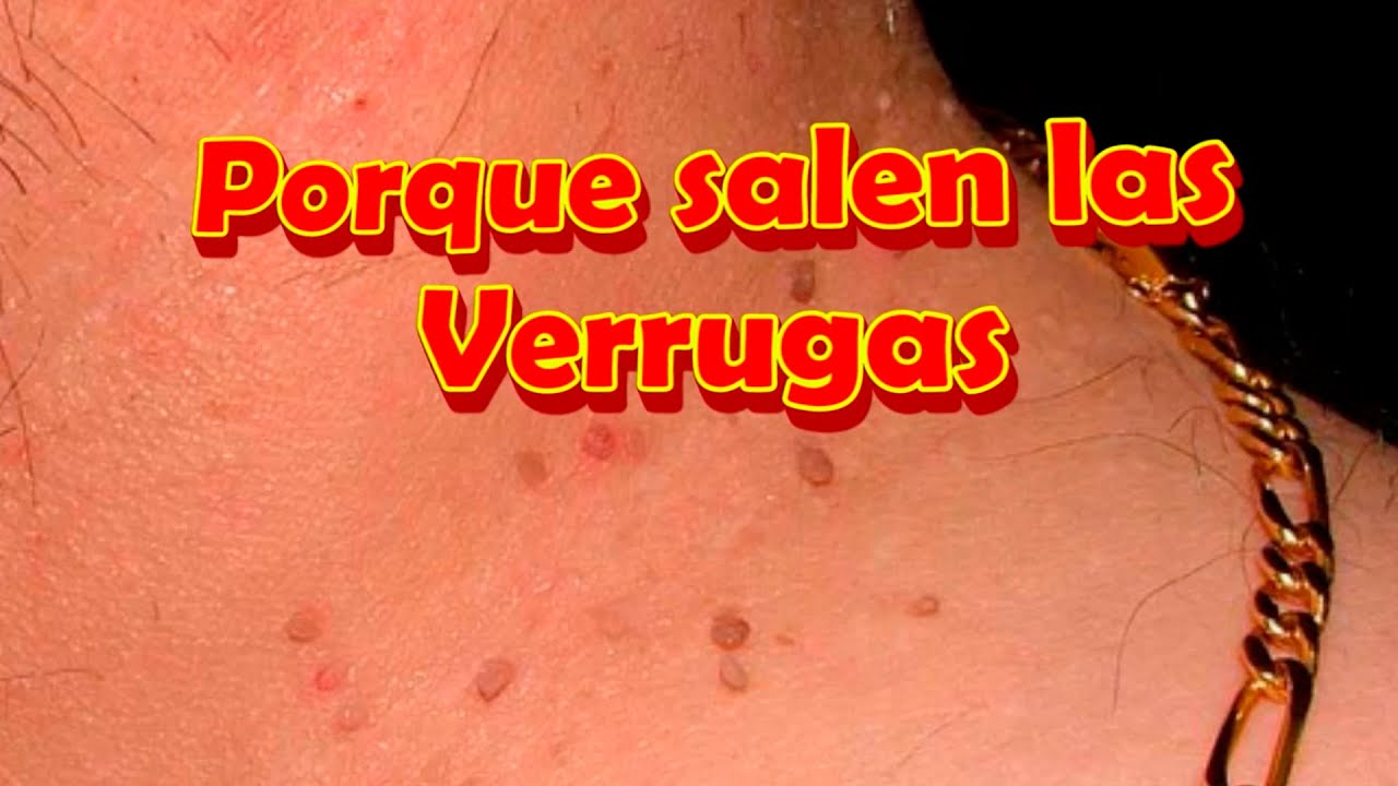 Porque Salen Las Verrugas En El Cuello En Los Genitales Tipos De