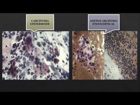 Carcinoma Vs Adenocarcinoma