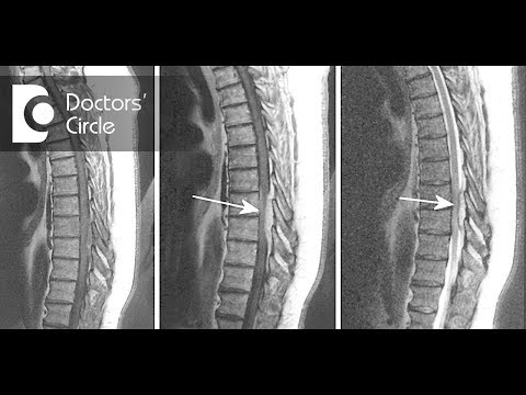 Guidelines for recovery from Pott's Spine with abscess - Dr. Mohan M R