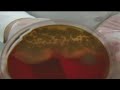 Texas Department Of State Health Services Warns Of Shigellosis Outbreak