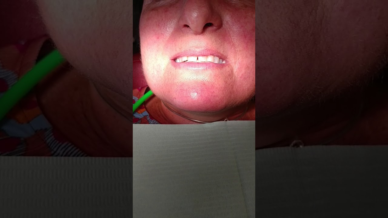 How to use an optragate for retraction of the lips in a dental