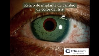 ¿Es peligroso cambiar los ojos de color | Cirugía de cambio de color de ojos | Iris implant removal