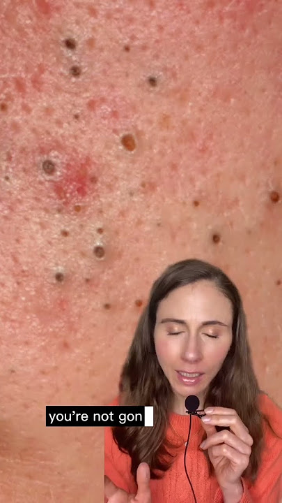 How to remove blackheads #dermatologist #blackheads #blackheadremoval