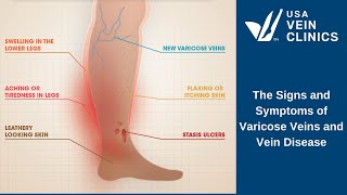 The Signs and Symptoms of Vein Disease and Varicose Veins