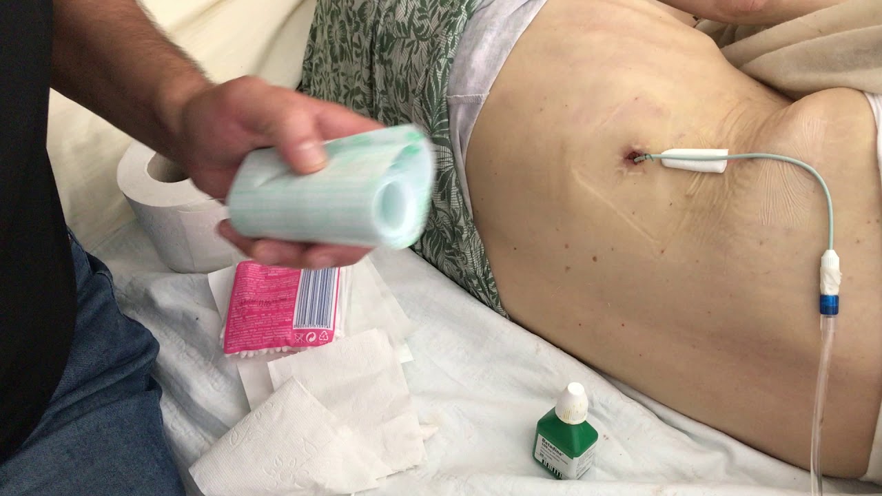 Нефростомы уход дома (русские субтитры) // Nephrostomy