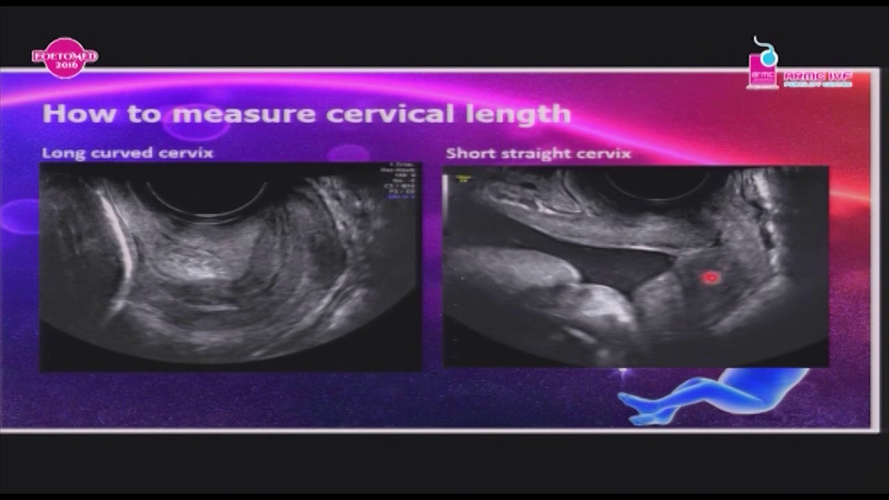 Cervix ; How short is too short? YouTube
