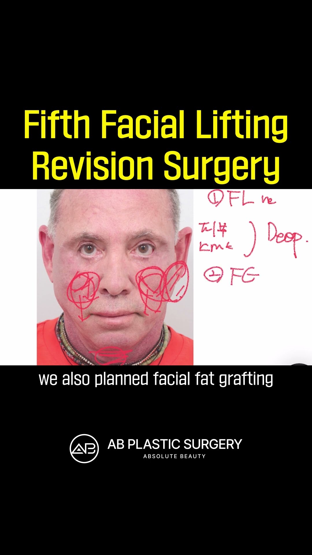 [Plastic Surgery in Korea] Fifth Facial Lifting Revision Surgery #abplasticsurgery