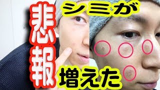 【悲報】カソーダで肌が炎症しシミやホクロも取れてない。