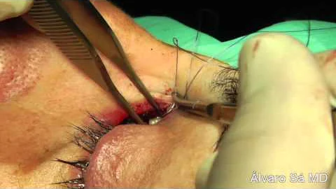Como é feita a cirurgia das vias lacrimais?