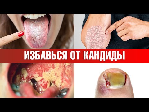 Как избавиться от кандидоза раз и навсегда?