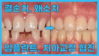 결손치, 왜소치 임플란트 치아교정 협진(상암동치아교정)