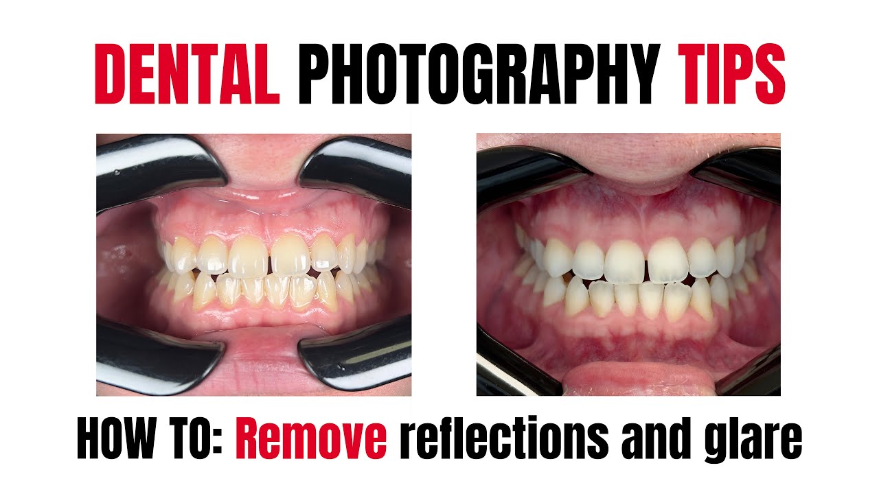 Dental Photography Tips: How to Remove all Reflections and Glare
