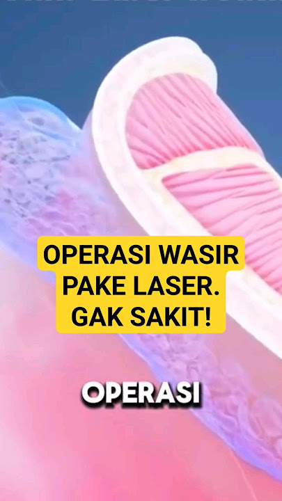 Operasi Wasir Pake Laser. Gak Pake Sakit. 2 jam setelah operasi sdh bisa jalan. #doctor #wasir