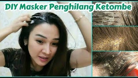 Cara Ampuh Hilangkan Ketombe Cepat & Permanen