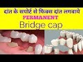 फिक्स दांत कैसे लगाए | Tooth supported bridge | How to fix tooth permanent |