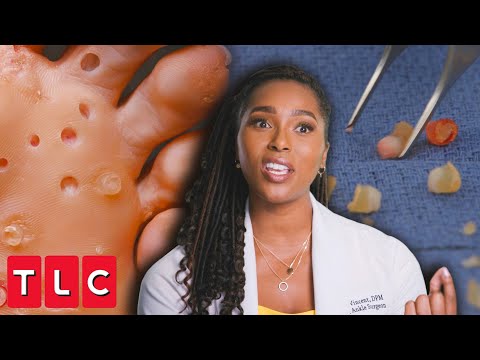 Dr. Ebonie Removes Over 200 Lesions From Patient's Feet! | My Feet Are Killing Me