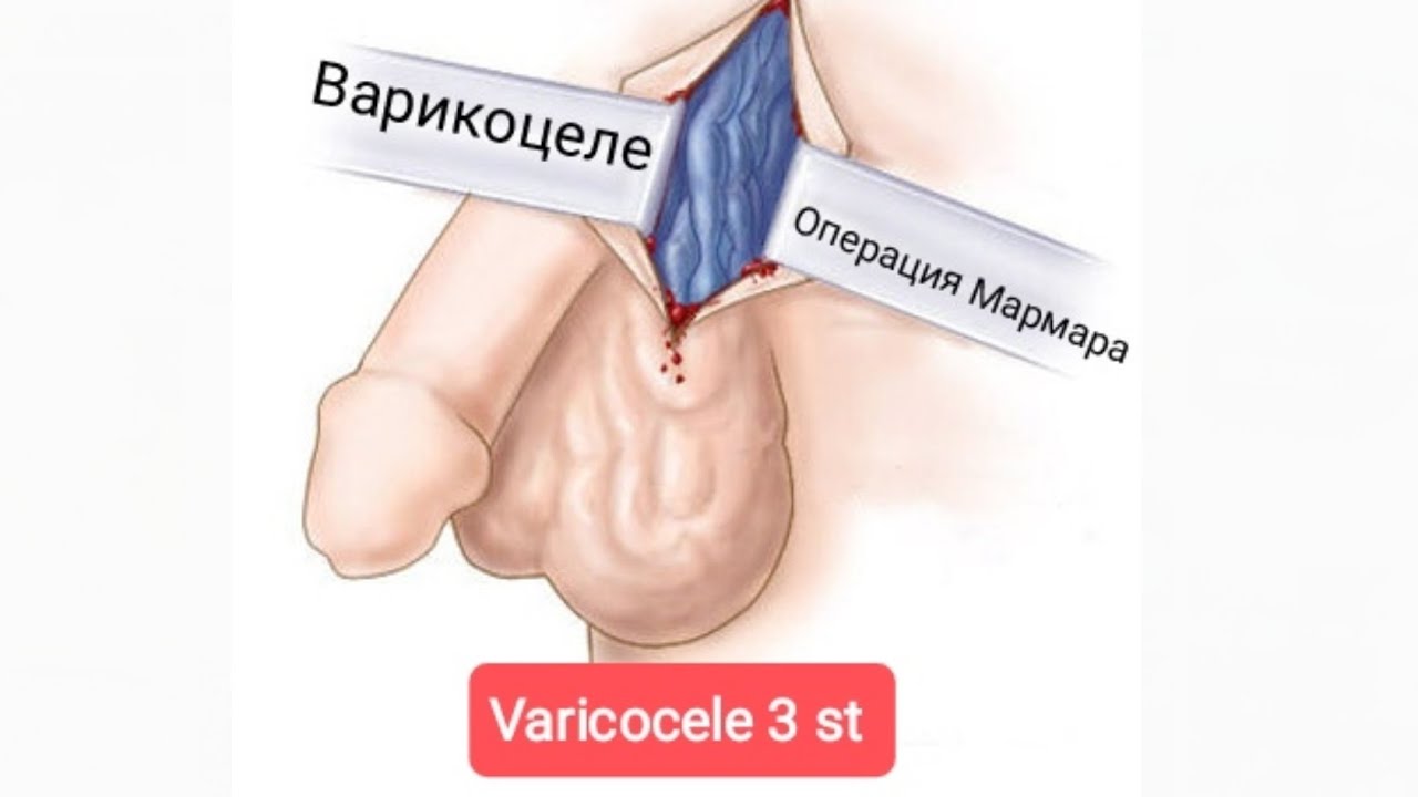 El varicocele puede desaparecer solo