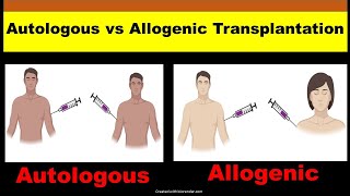 Autologous vs Allogeneic Transplant | Autologous and Allogeneic Stem Cell Transplantation |