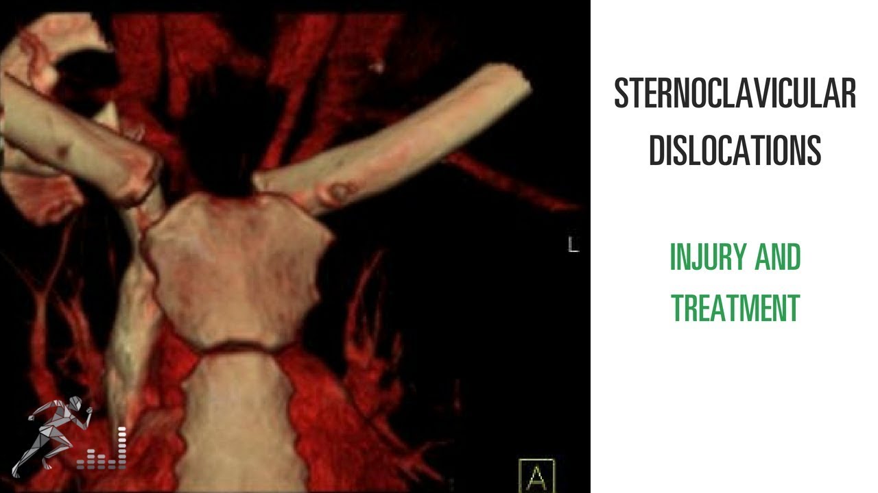 Вывих грудино-ключичного сочленения: механизм травмы и лечение вывиха грудино-ключичного сочленения