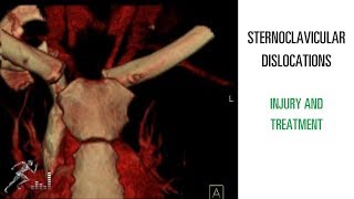 SC dislocation: Mechanism of injury and treatment of a sternoclavicular dislocation