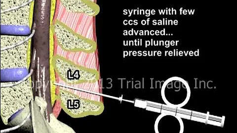 Epidural Spinal Anesthesia - Animation by Dr. Cal Shipley, M.D.