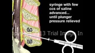 Epidural Spinal Anesthesia - Animation by Dr. Cal Shipley, M.D.