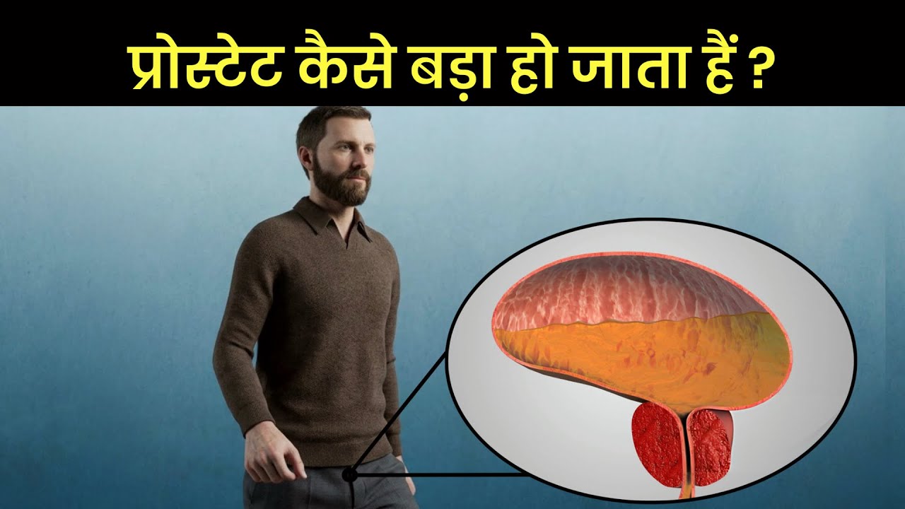 प्रोस्टेट बड़ा कैसे हो जाता है? Benign Prostatic Hyperplasia 