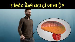 प्रोस्टेट बड़ा कैसे हो जाता है? Benign Prostatic Hyperplasia 