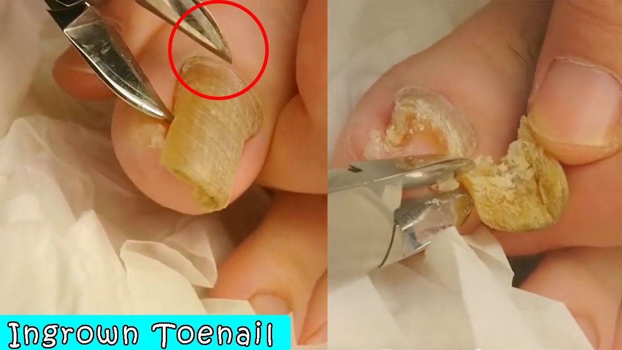 Ingrown Toenail Surgery How To Removal Treatment Youtube