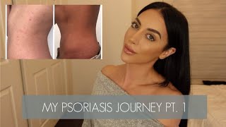 PSORIASIS JOURNEY PT. 1 : HOW I CLEARED MY PSORIASIS AND GOT MY LIFE BACK