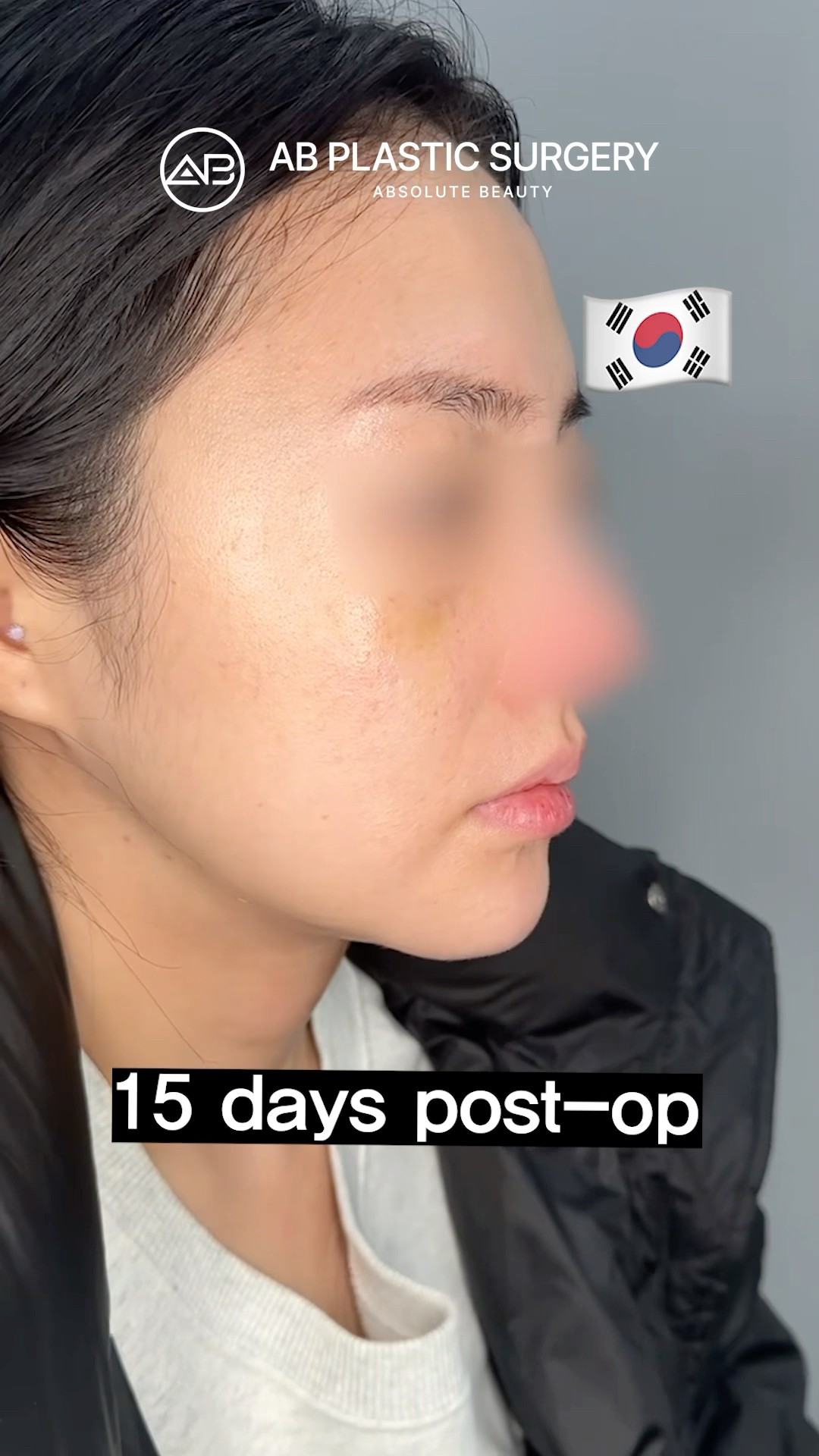 Double Chin ERASED! #koreanplasticsurgery