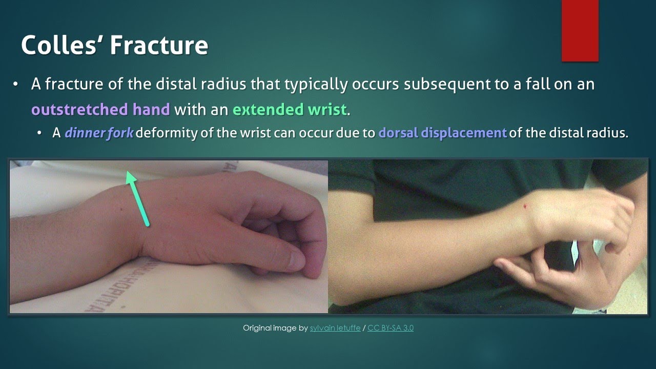 Colles' Fracture 