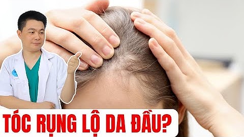 Rụng Tóc Toàn Da Đầu ! Nguyên Nhân Và Cách Điều Trị Hiệu Quả | Bác Sĩ Chiều