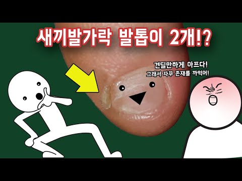 새끼 발가락 발톱은 왜 자꾸 두 개로 갈라질까?