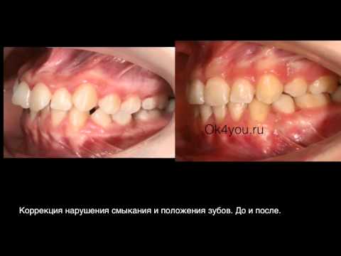 Ортодонтическое исправление положения клыков