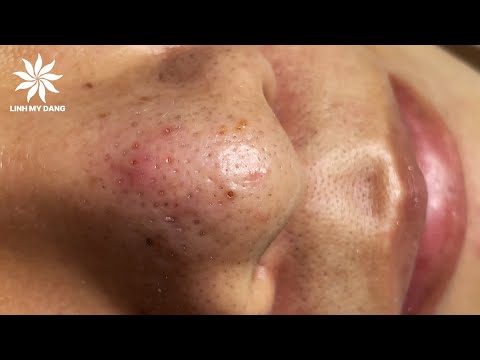 Relaxing Acne Treatment #26 | The Nose
