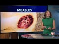 Several measles cases confirmed in Western New York; Health official weighs in on staying safe