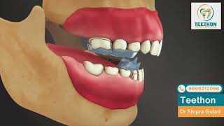 Twin block Orthodontic appliance 