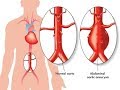 AORT ANEVRİZMALARININ TANISI, TEDAVİSİ VE YÖNETİMİ