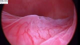 Operative Hysteroscopy (Submucous Myomectomy) with Dr.Amit T