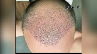 Пересадка волос, результат за месяц